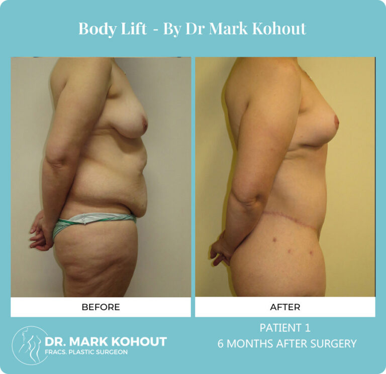 Body Lift Before and After Photos