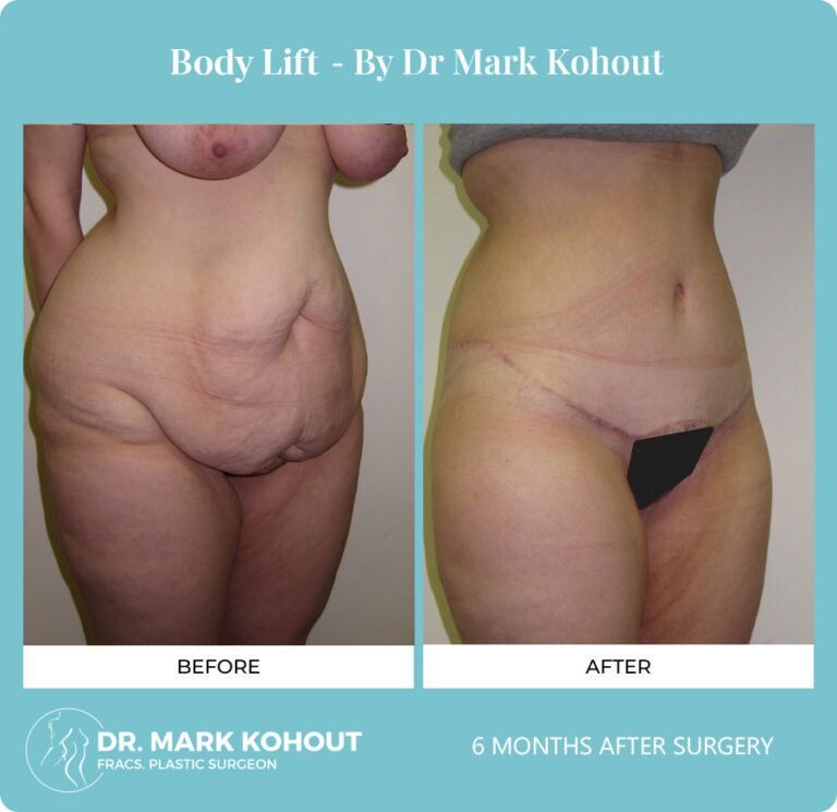 Body-Lift-Patient-2-45