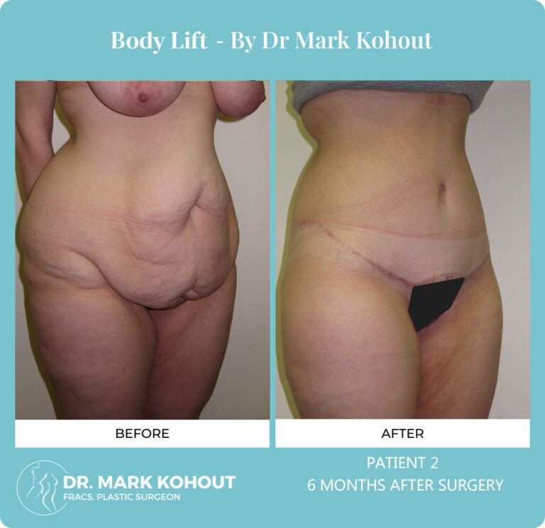 Body Lift Before and After Photos