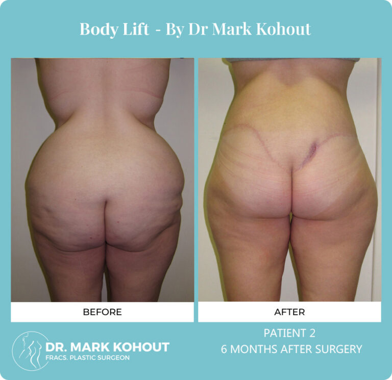 Body Lift Before and After Photos
