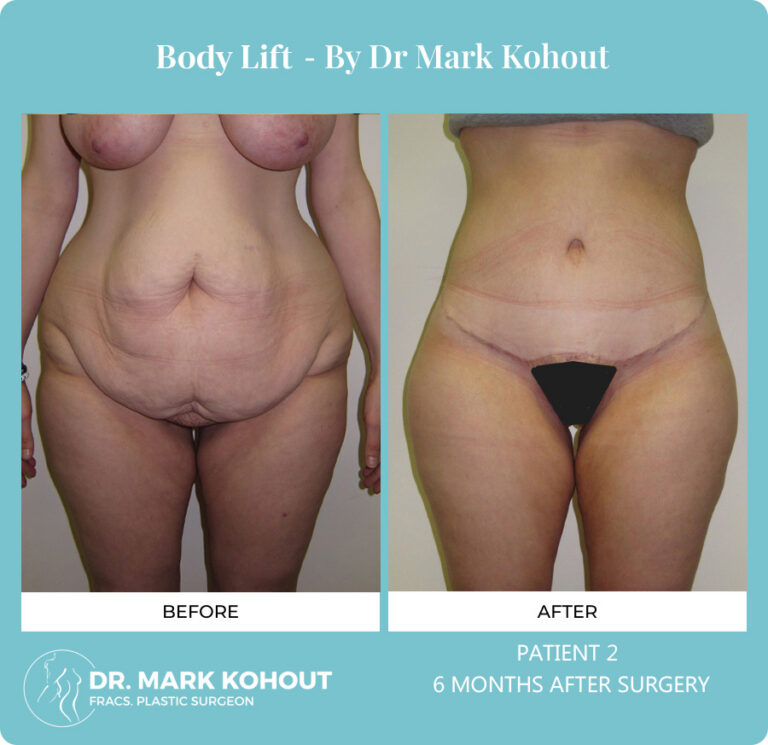 Body Lift Before and After Photos