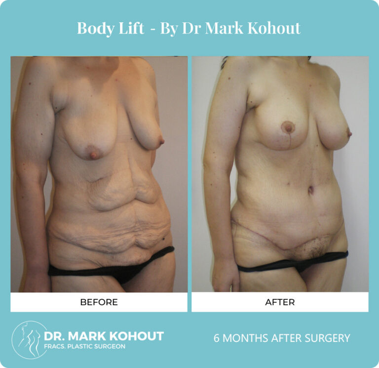 Body-Lift-Patient-3-45