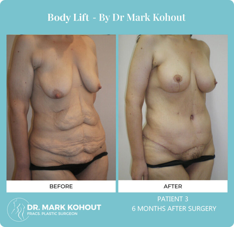 Body Lift Before and After Photos