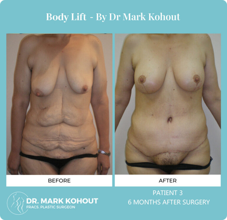 Body Lift Before and After Photos
