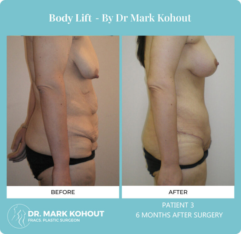Body Lift Before and After Photos