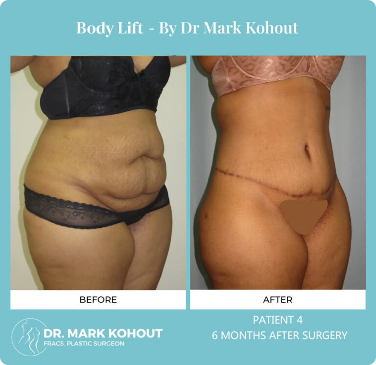 Body Lift Before and After Photos