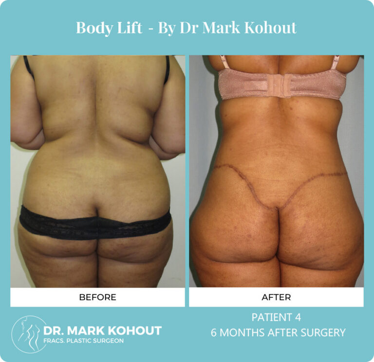 Body Lift Before and After Photos