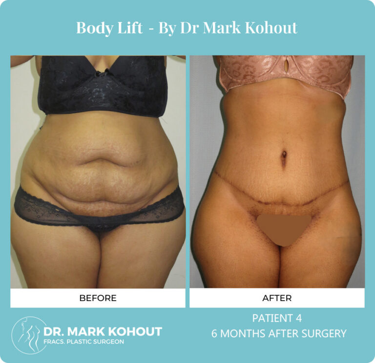 Body Lift Before and After Photos