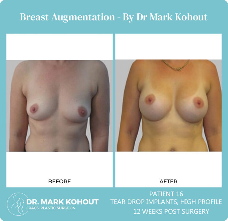 Breast Augmentation Patient