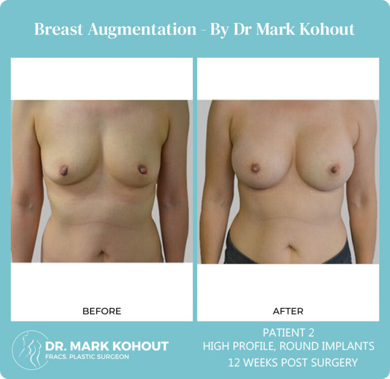 Breast Augmentation Patient