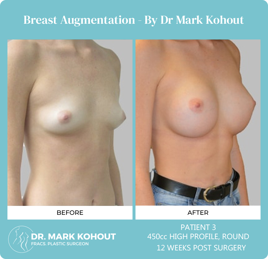Breast Augmentation Patient
