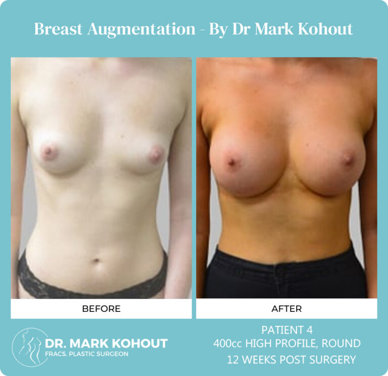 Breast Augmentation Patient