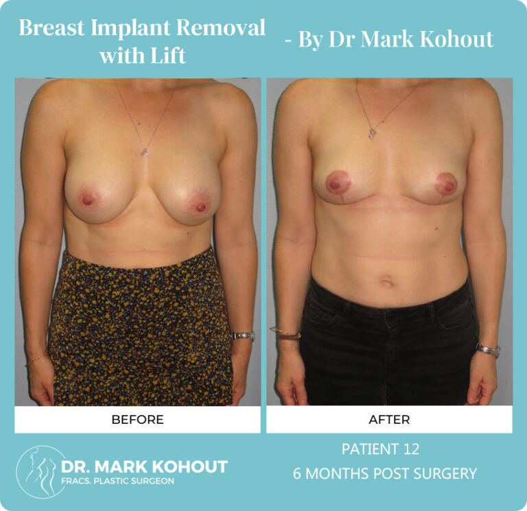 Breast Implant Removal Before and After Photos