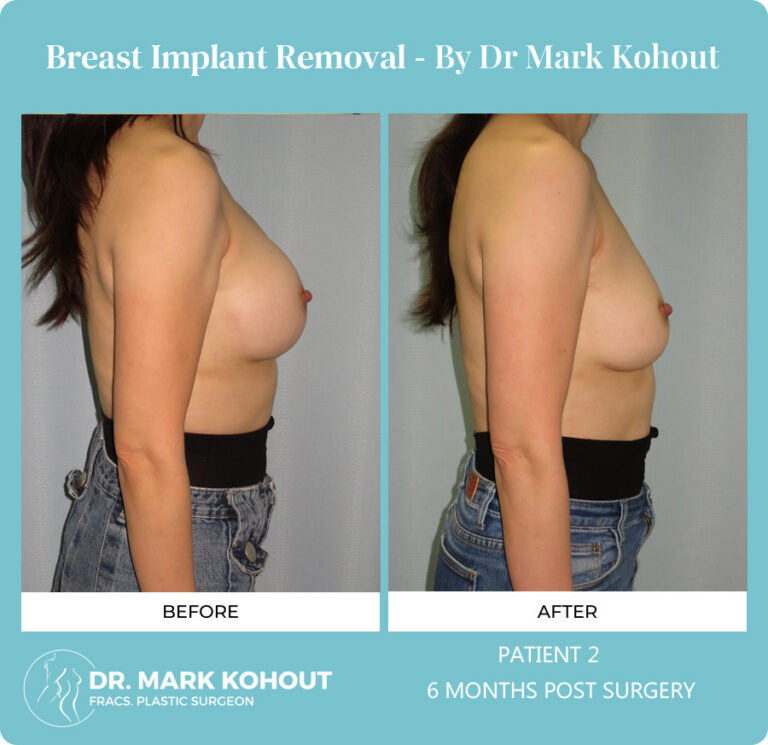 Breast Implant Removal Before and After Photos
