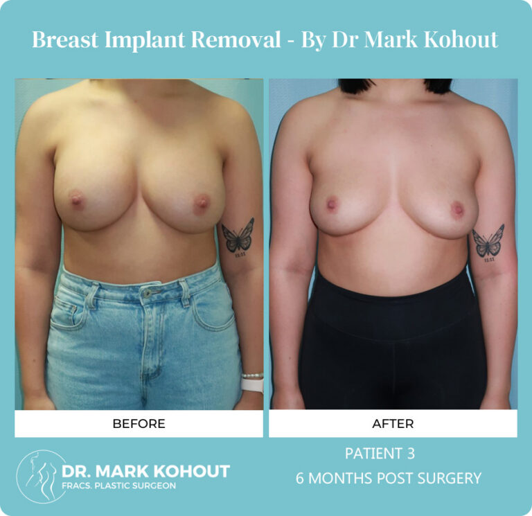 Breast Implant Removal Before and After Photos