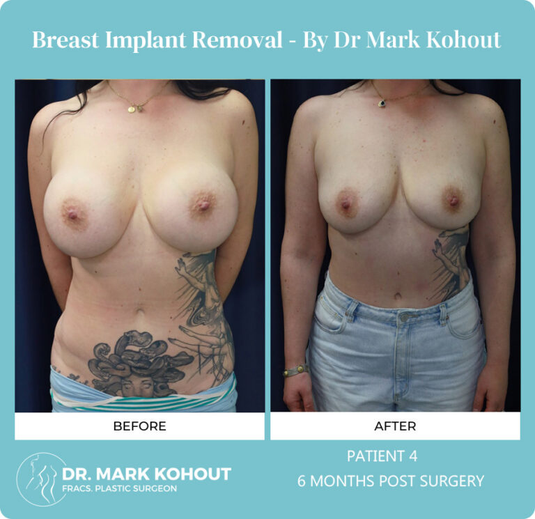 Breast Implant Removal Before and After Photos