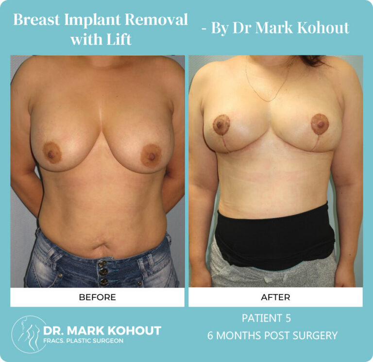 Breast Implant Removal Before and After Photos
