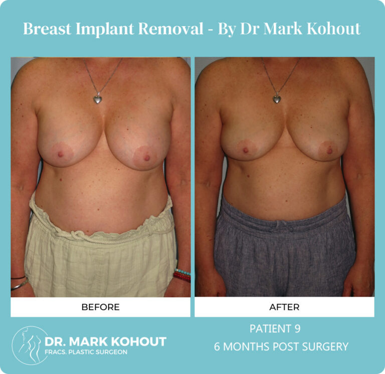Breast Implant Removal Before and After Photos