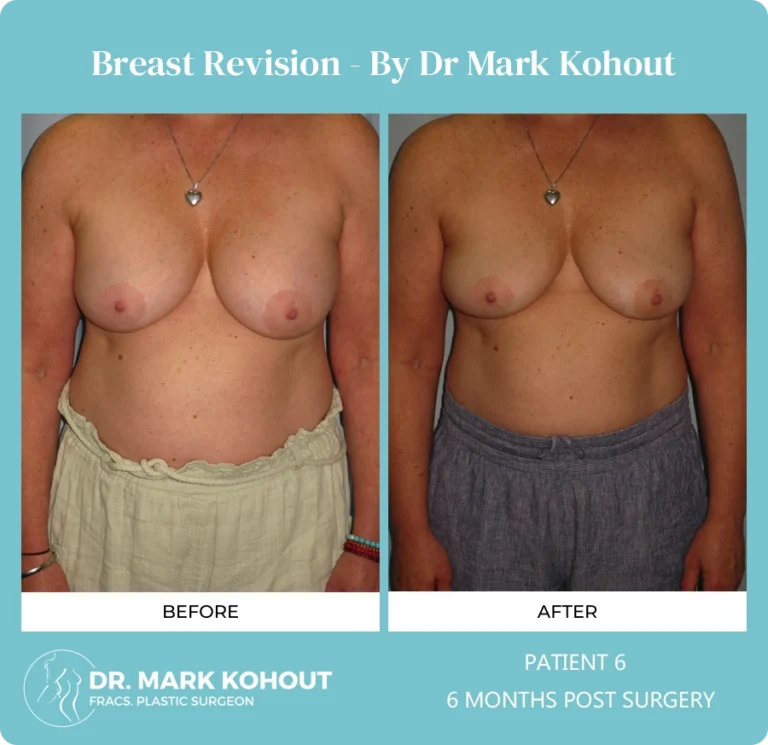 Breast Revision Patient 6 front