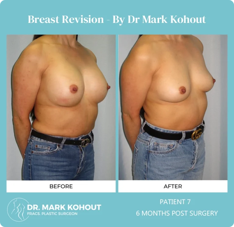 Breast Revision Patient 7 45