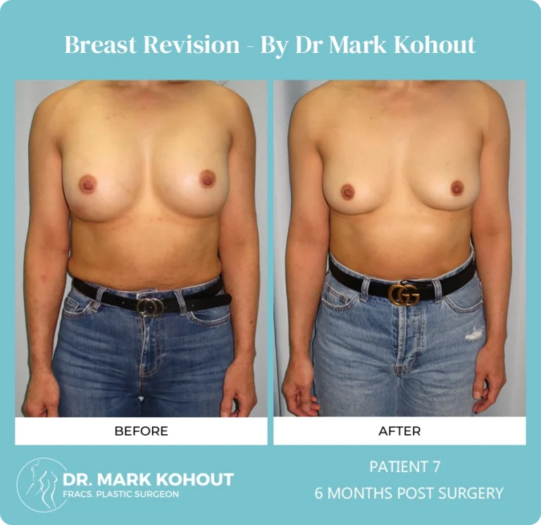 Breast Revision Patient 7 front