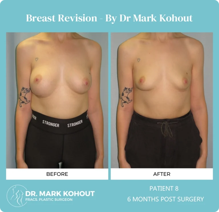 Breast Revision Patient 8 front