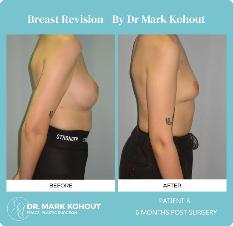 Breast Revision Patient 8 side