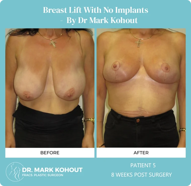 Patient 5 - 8 Weeks Post Surgery