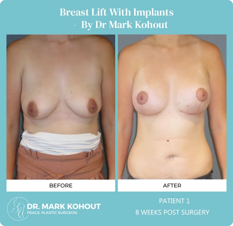 Patient 1 - 8 Weeks Post Surgery
