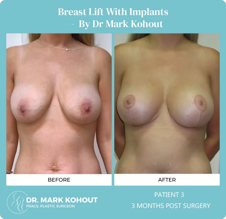 Patient 3 - 3 Months Post Surgery