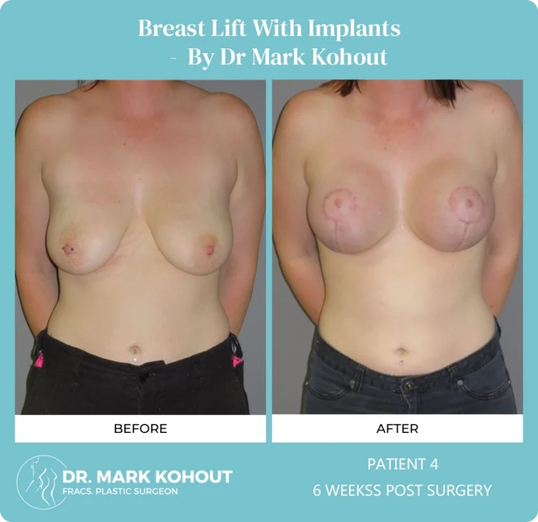 Patient 4 - 6 Weeks Post Surgery