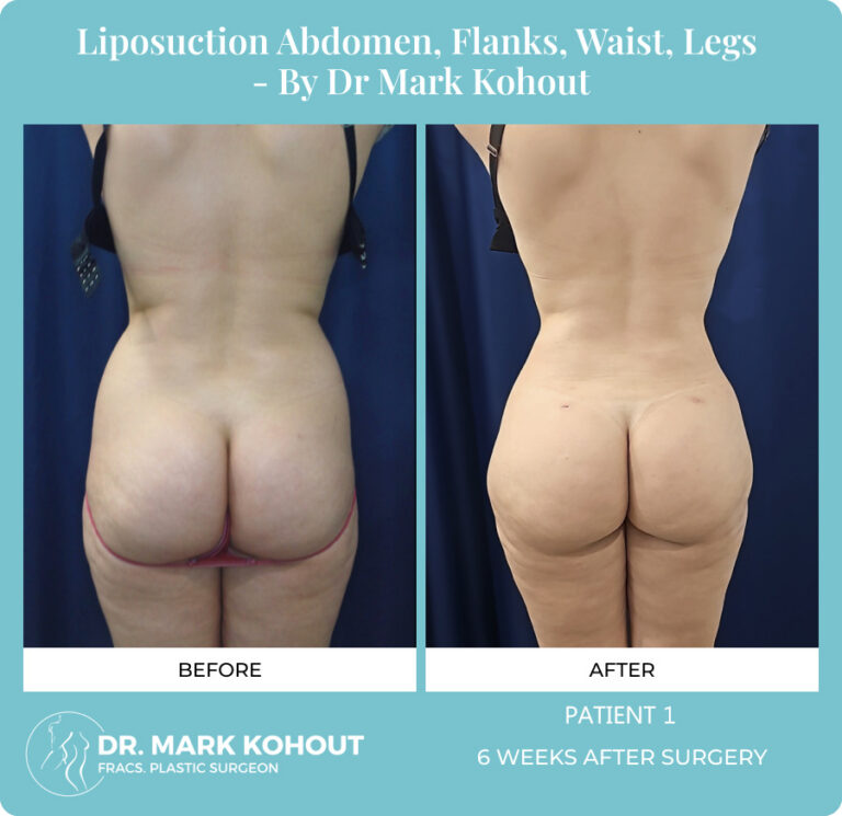 Liposuction Before and After Photos