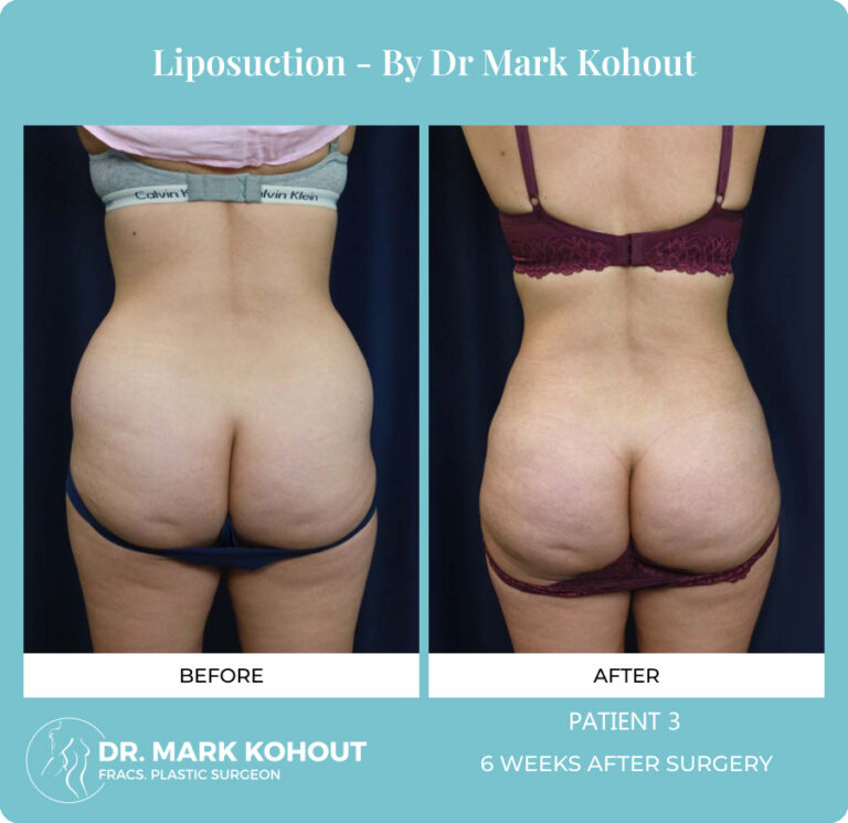 Liposuction Before and After Photos