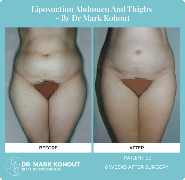 Liposuction Before and After Photos