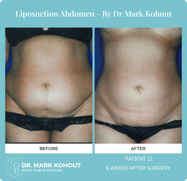 Liposuction Before and After Photos