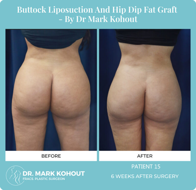 Liposuction Before and After Photos