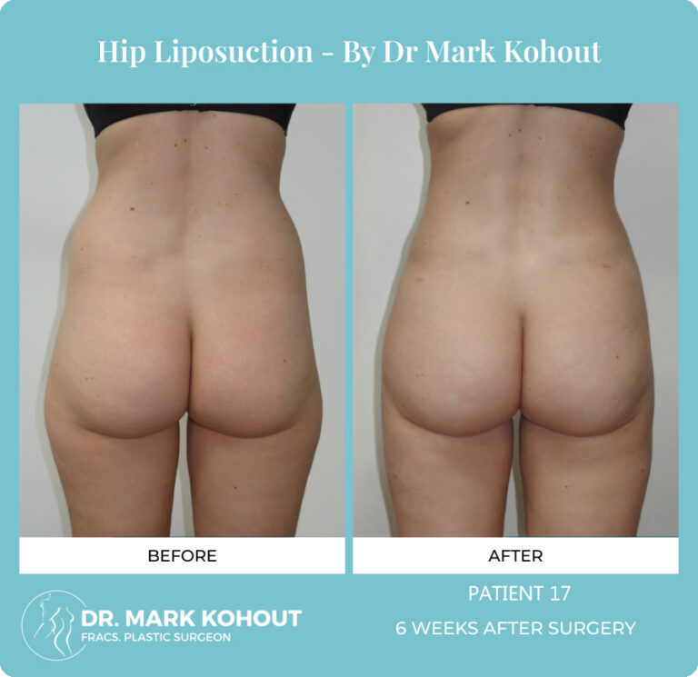 Liposuction Before and After Photos