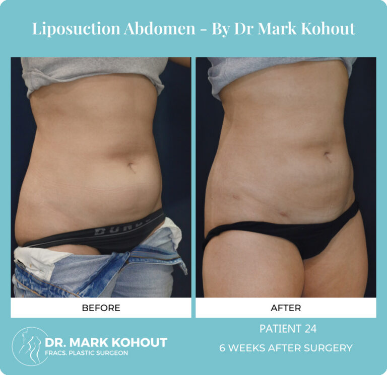 Liposuction Before and After Photos