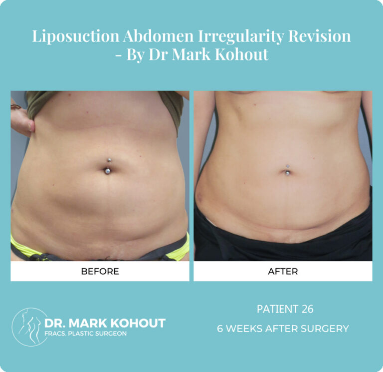 Liposuction Before and After Photos