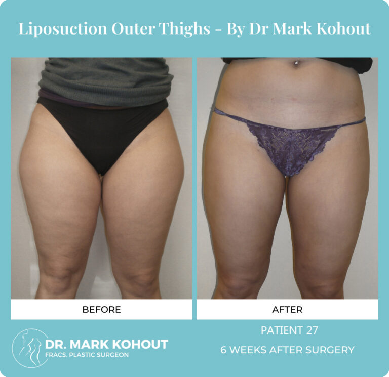 Liposuction Before and After Photos