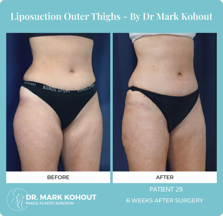 Liposuction Before and After Photos