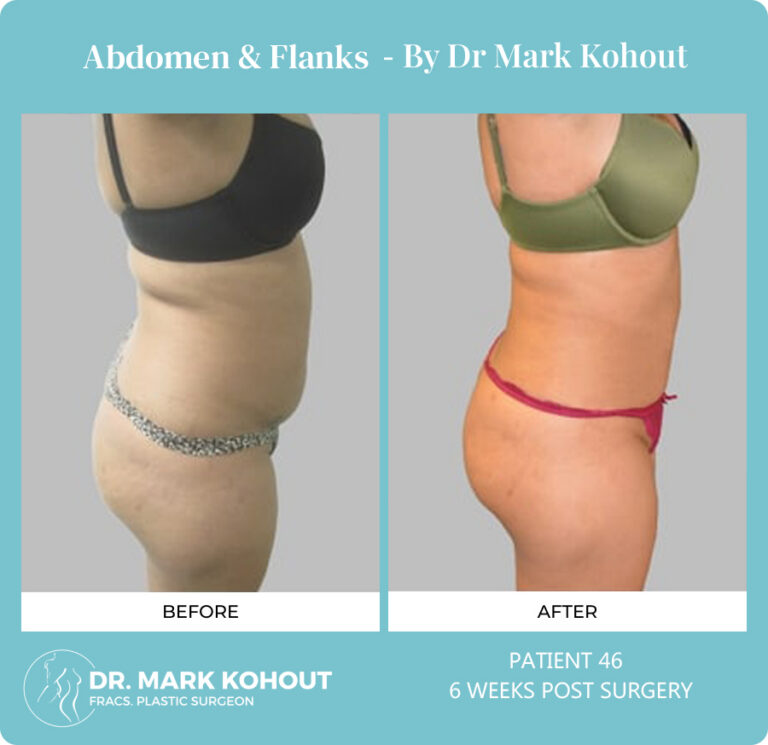 Liposuction Before and After Photos - Abdomen and Flanks