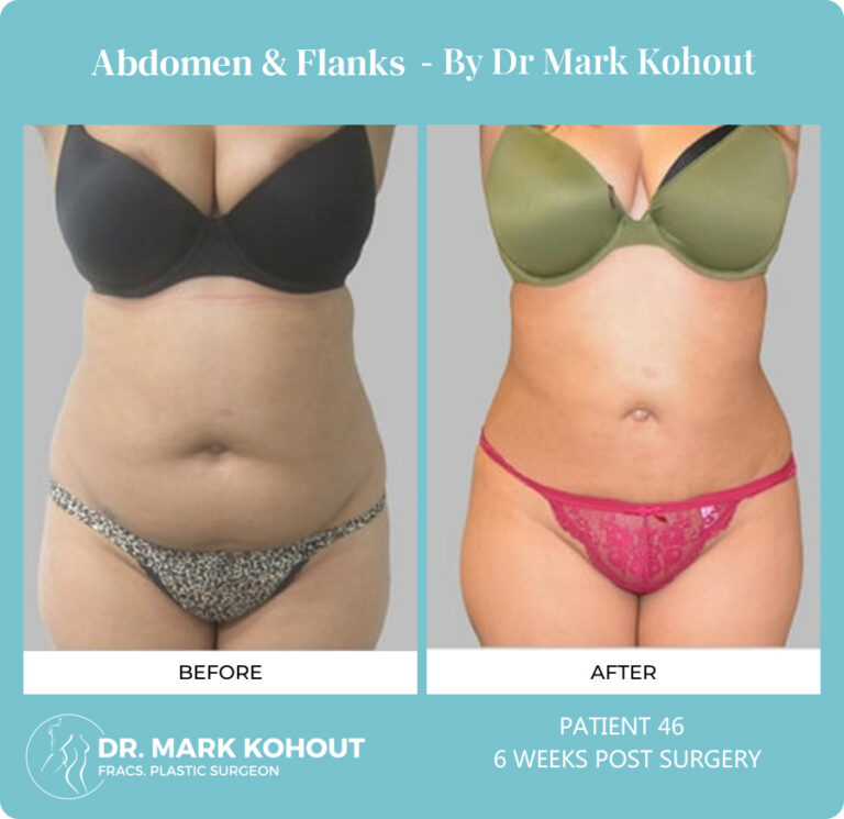 Liposuction Before and After Photos - Abdomen and Flanks