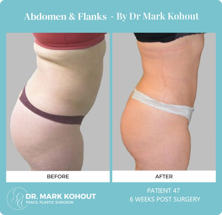 Liposuction Before and After Photos - Abdomen and Flanks