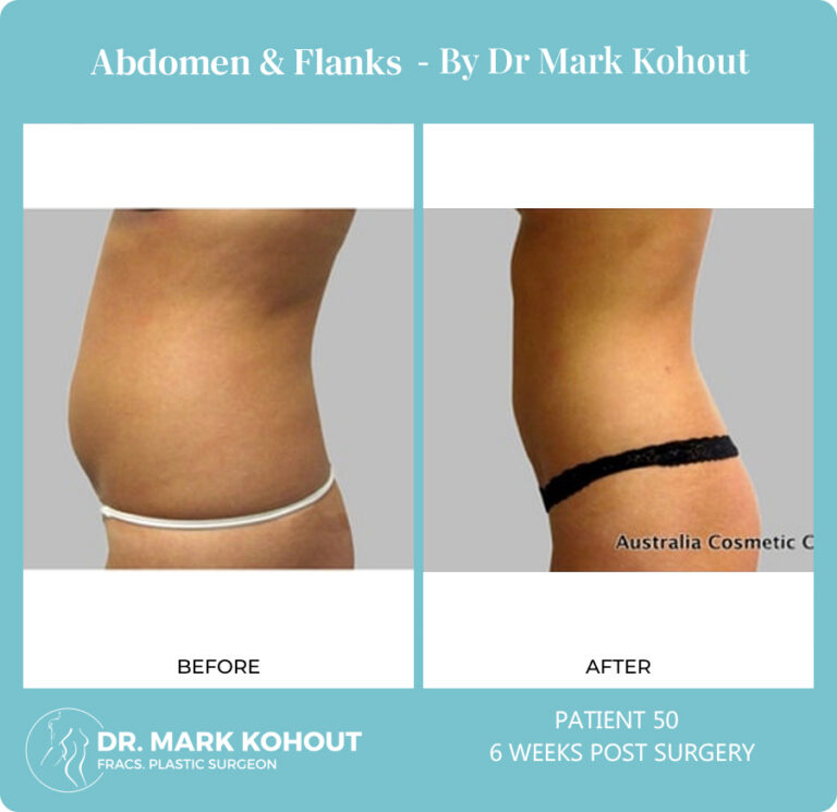 Liposuction Before and After Photos - Abdomen and Flanks