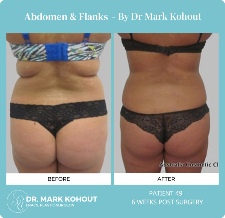 Liposuction Before and After Photos - Abdomen and Flanks