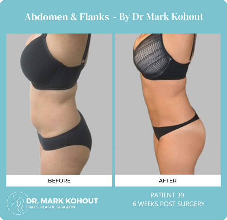 Liposuction Before and After Photos - Abdomen and Flanks