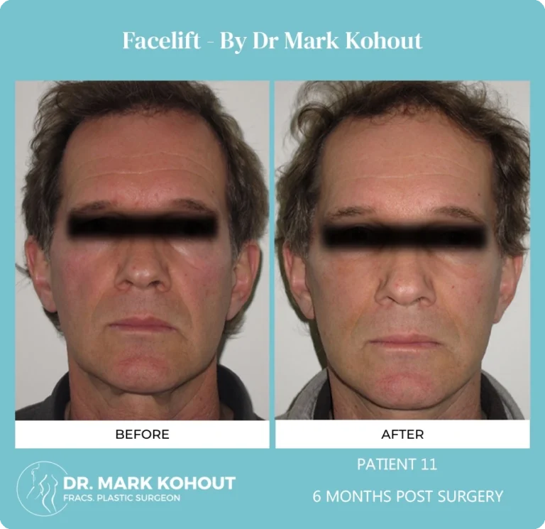 Patient 12 - 6 Months Post Surgery