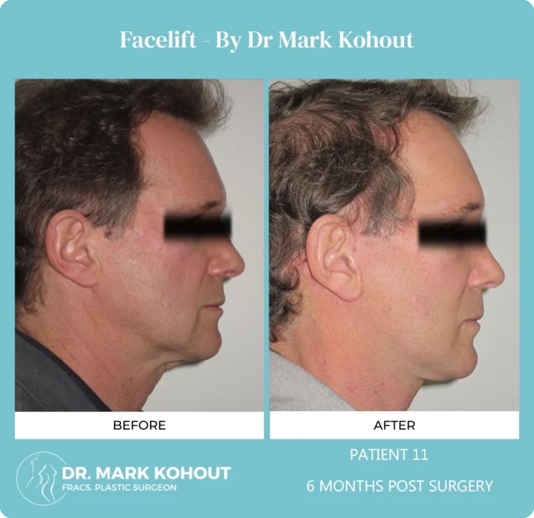 Patient 12 - 6 Months Post Surgery