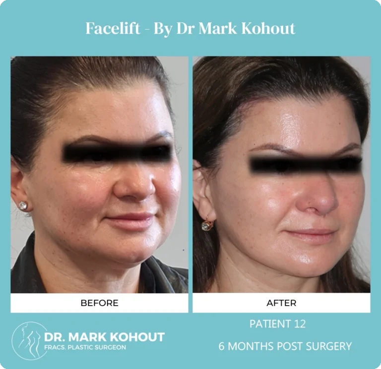 Patient 13 - 6 Months Post Surgery